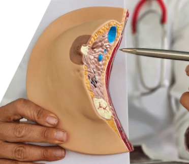 удаление фиброаденомы молочной железы удаление фиброаденомы молочной железы